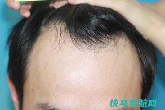 发际线后移怎么办？如何正确洗头？